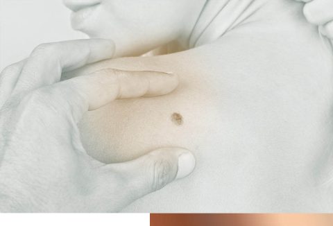 Skin Cancer Screening Private Cancer Screening London